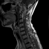 Resonancia Magnética Cervical